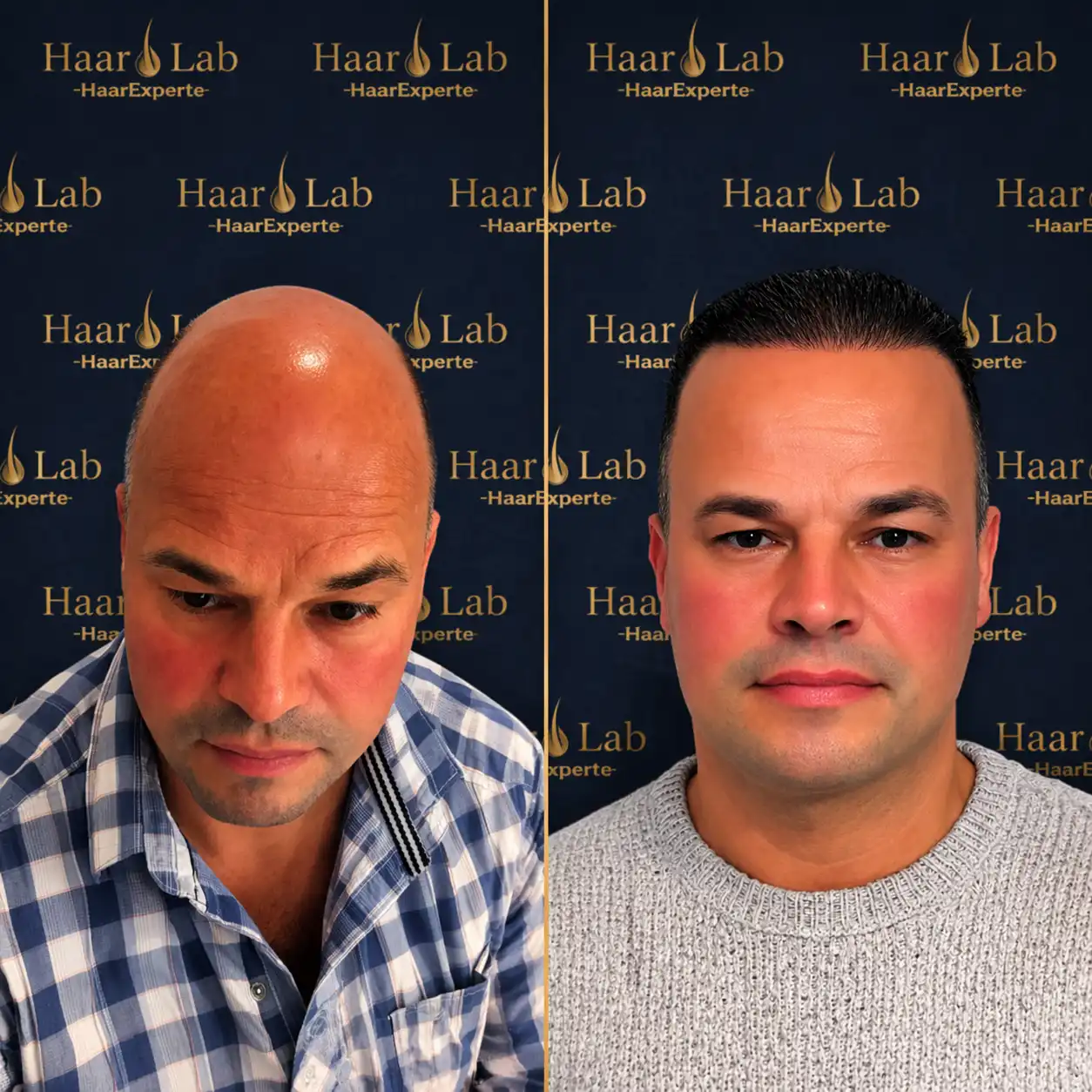 Haartransplantation