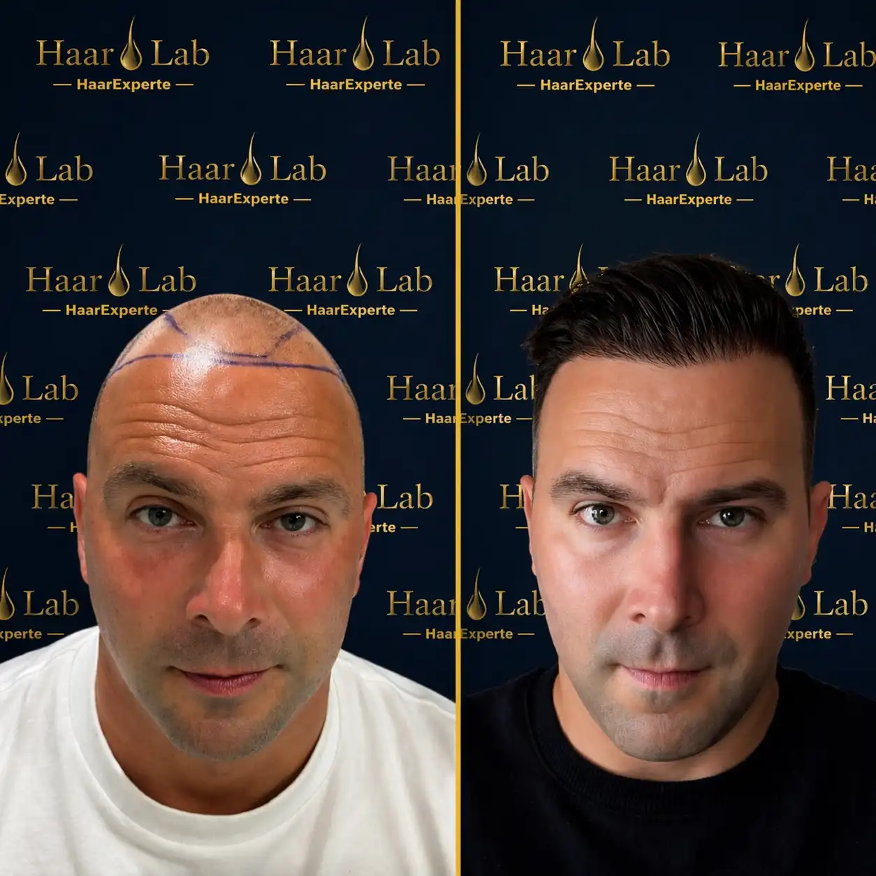 Haartransplantation