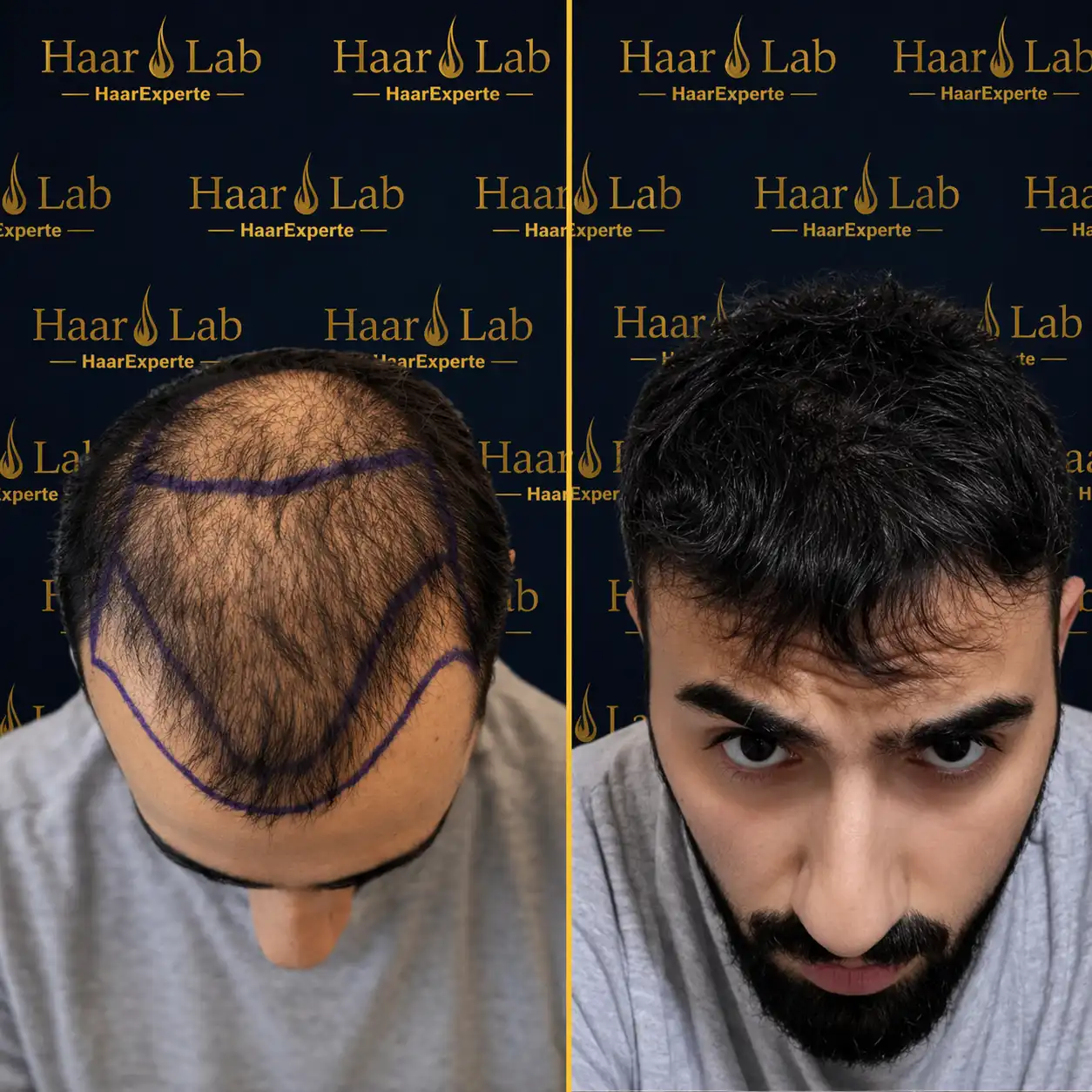 Haartransplantation