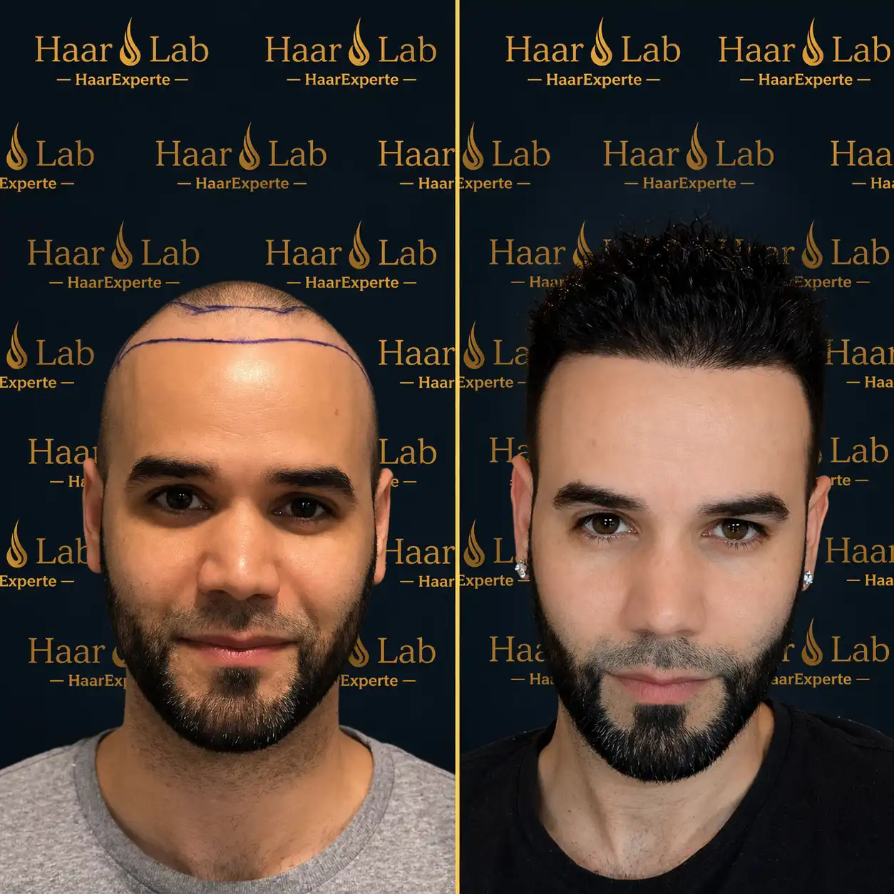 Haartransplantation