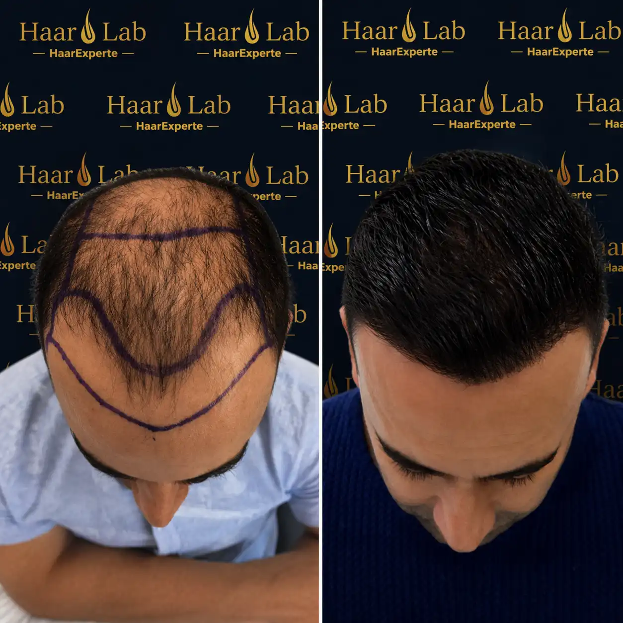 Haartransplantation
