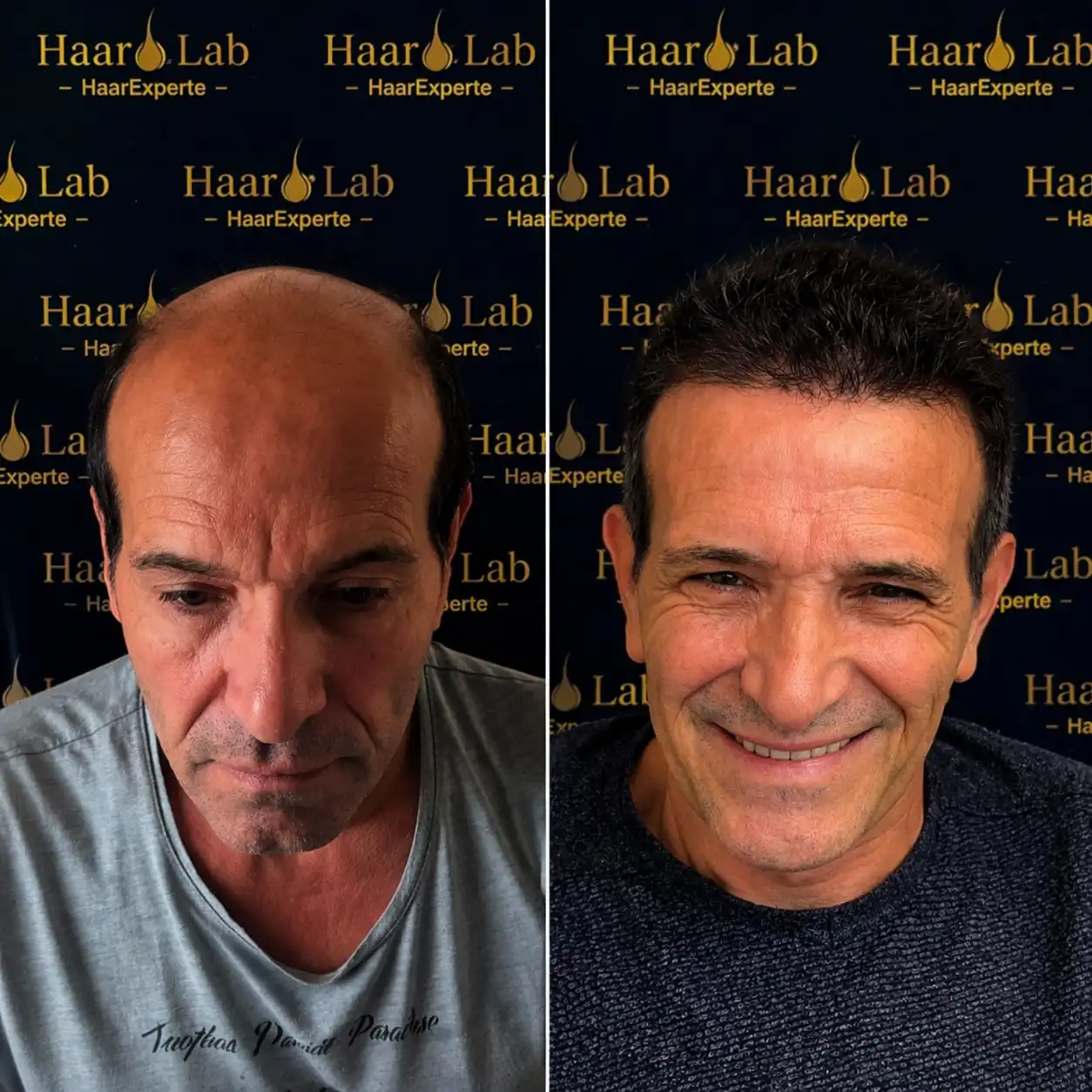 Haartransplantation