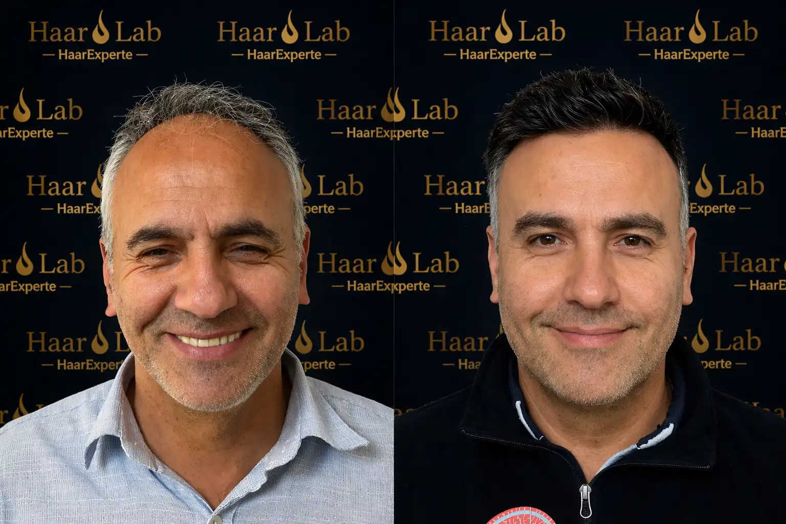 Haartransplantation
