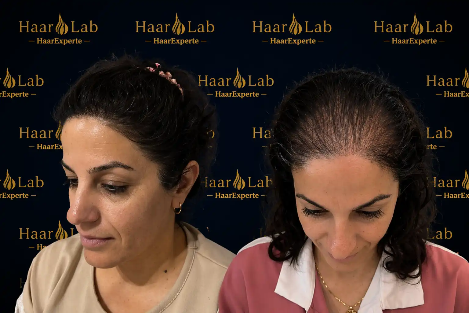 Haartransplantation Frauen