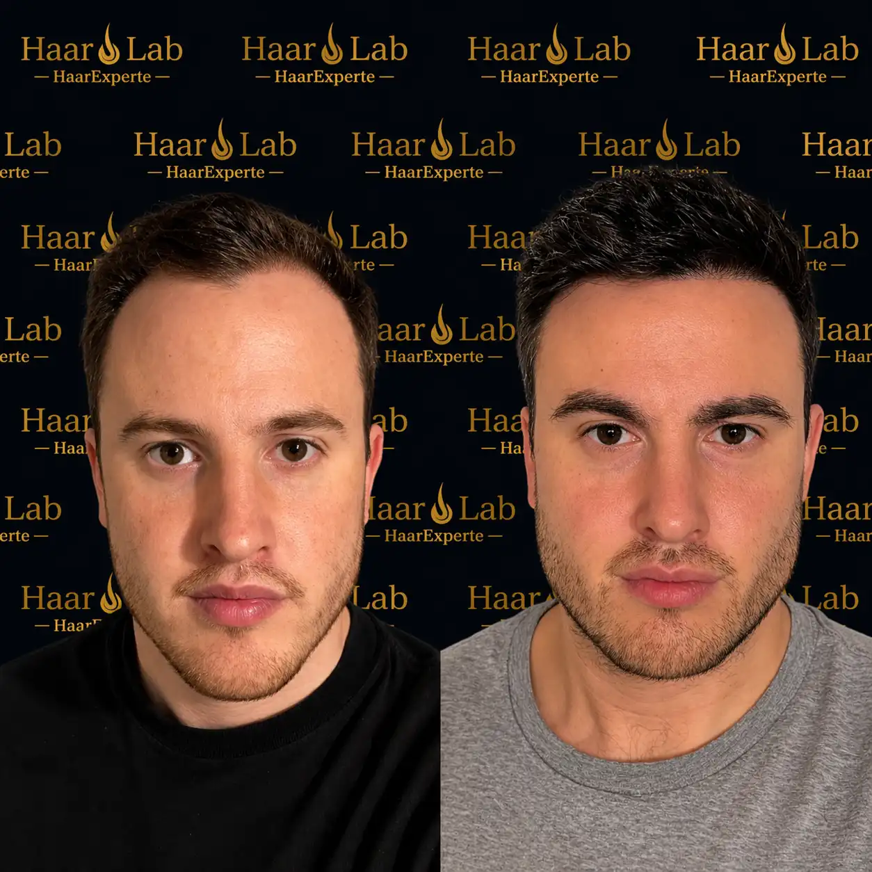 Haartransplantation