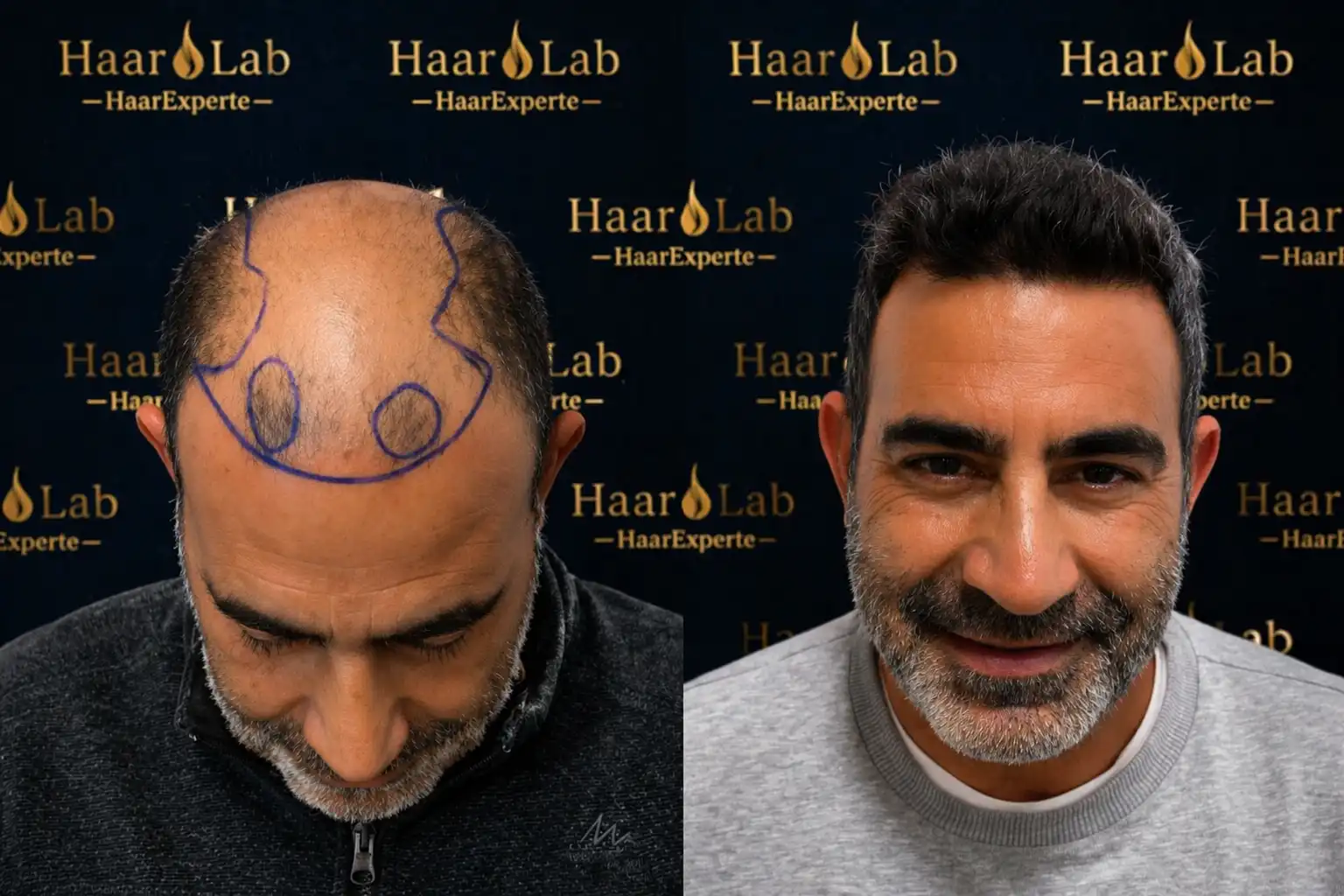 Haartransplantation