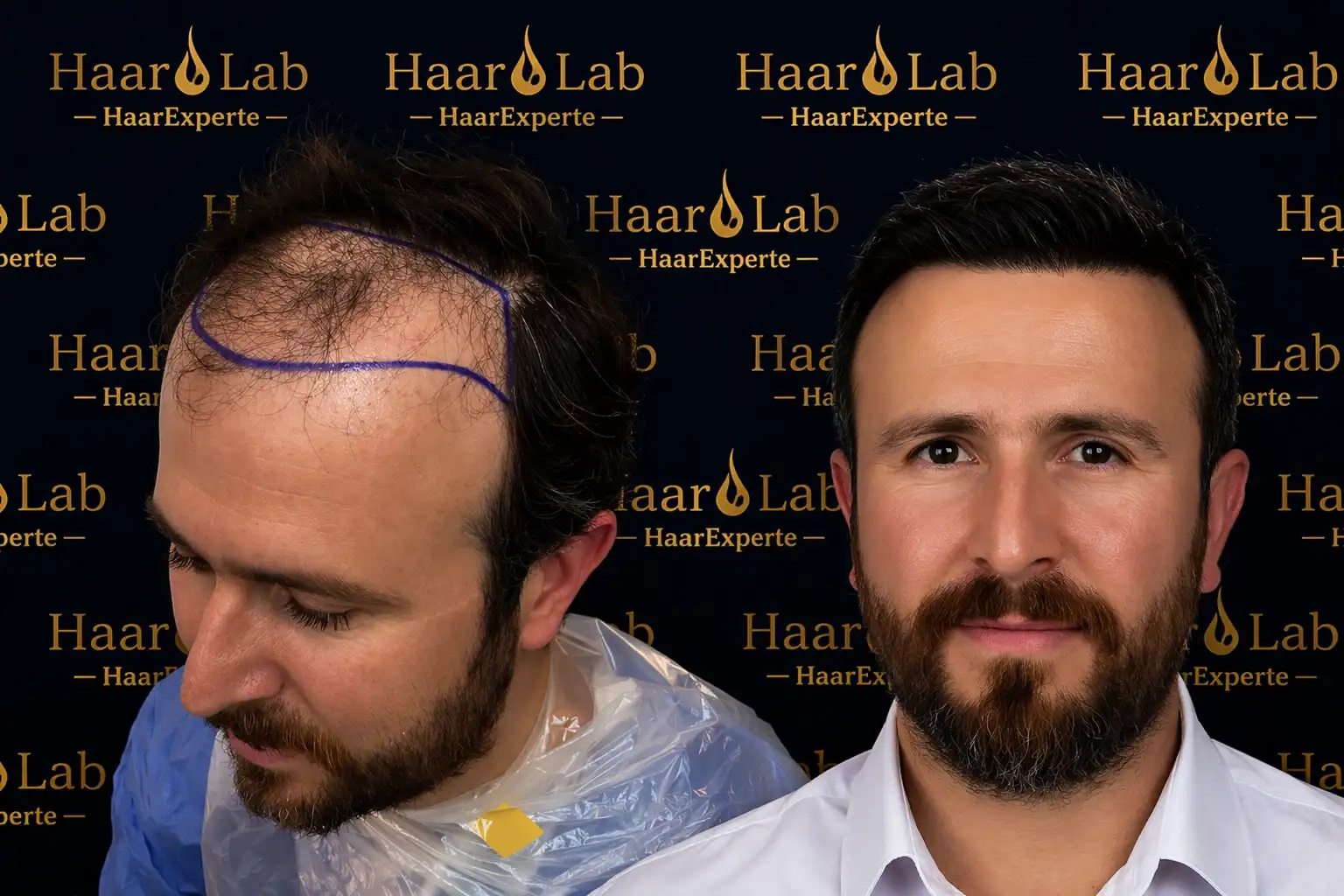 Haartransplantation