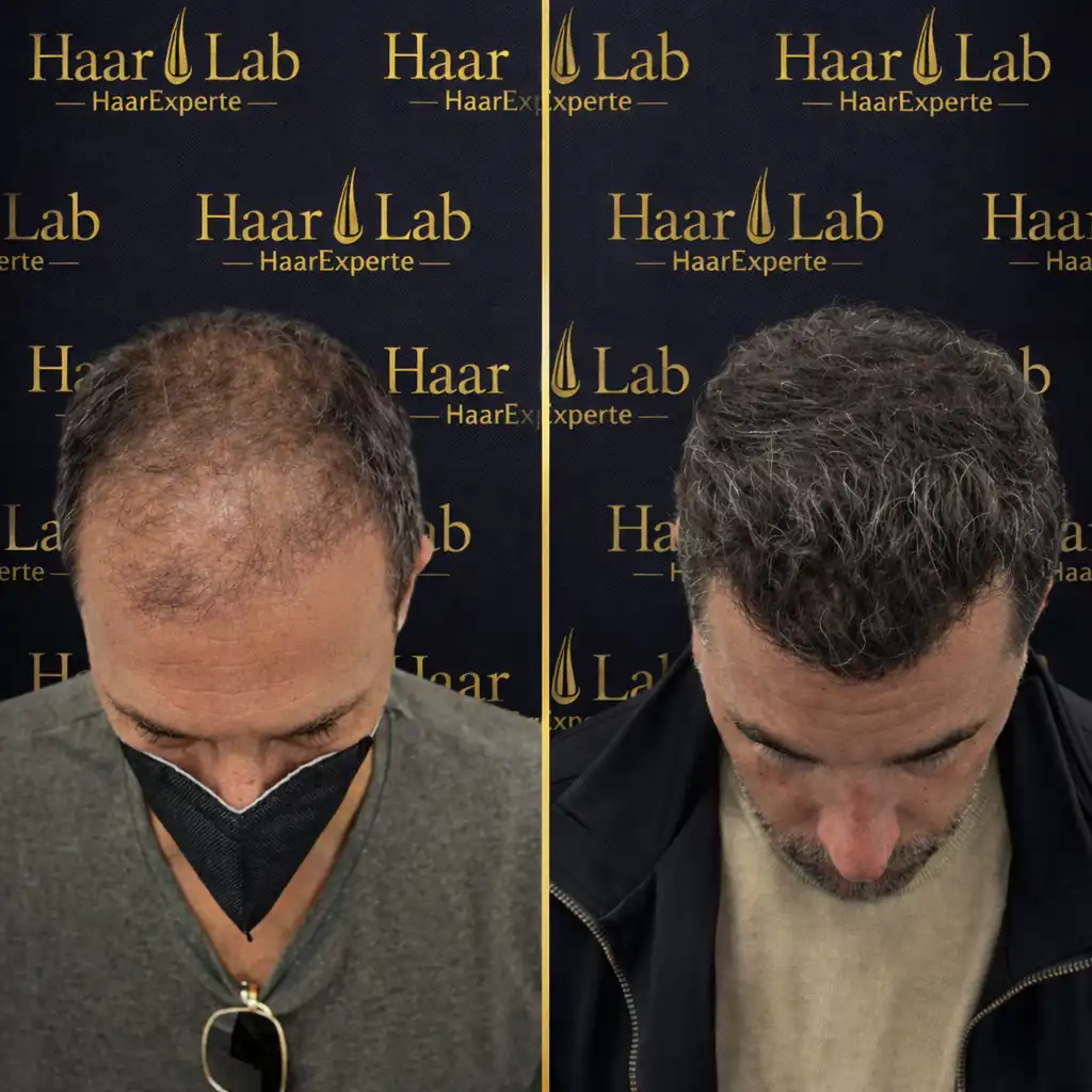 Haartransplantation