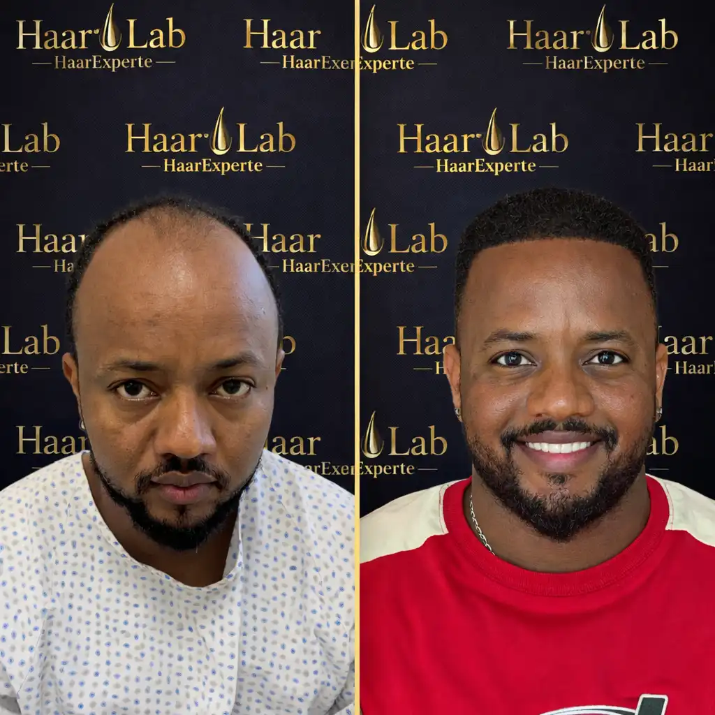 Haartransplantation