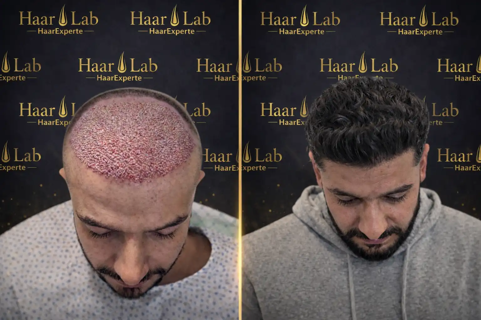 Haartransplantation