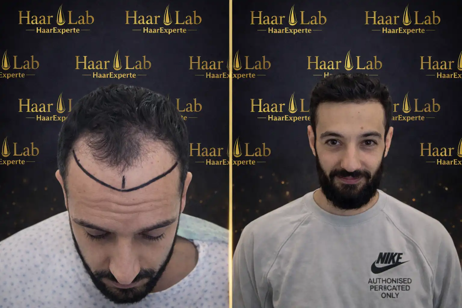 Haartransplantation