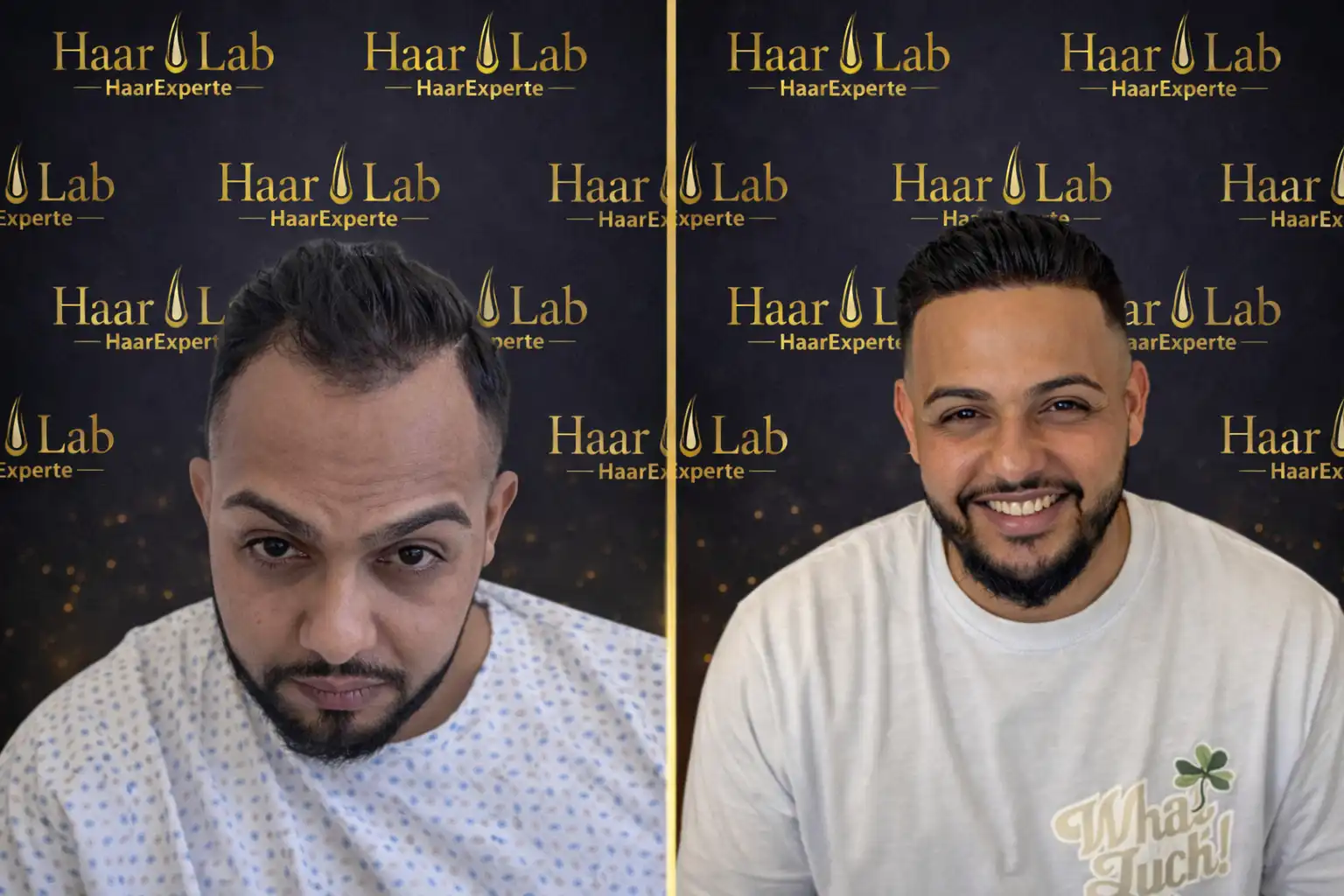 Haartransplantation