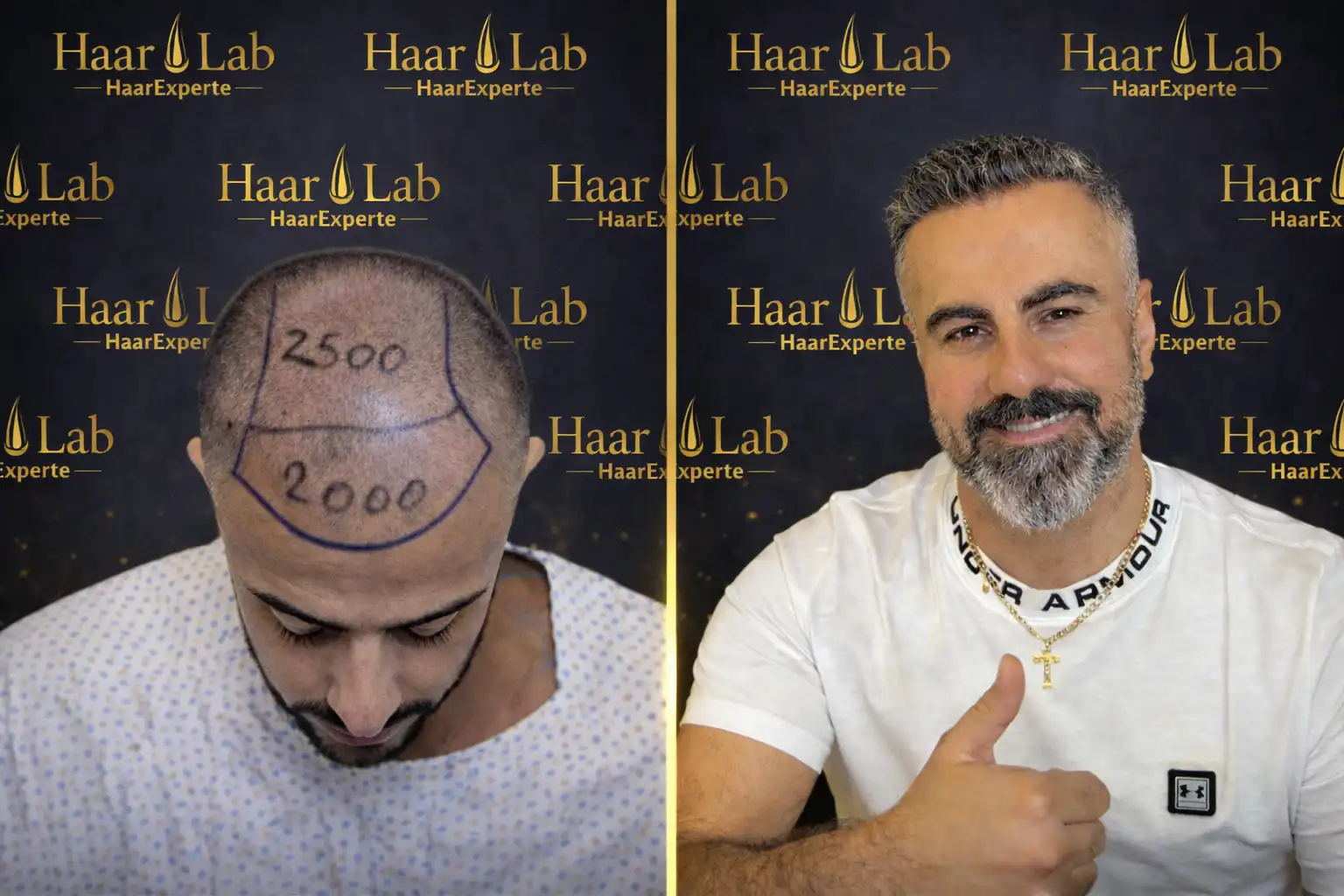 Haartransplantation