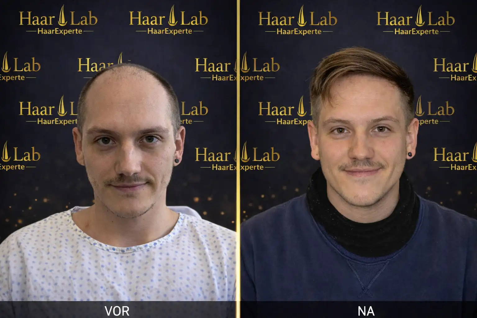 Haartransplantation