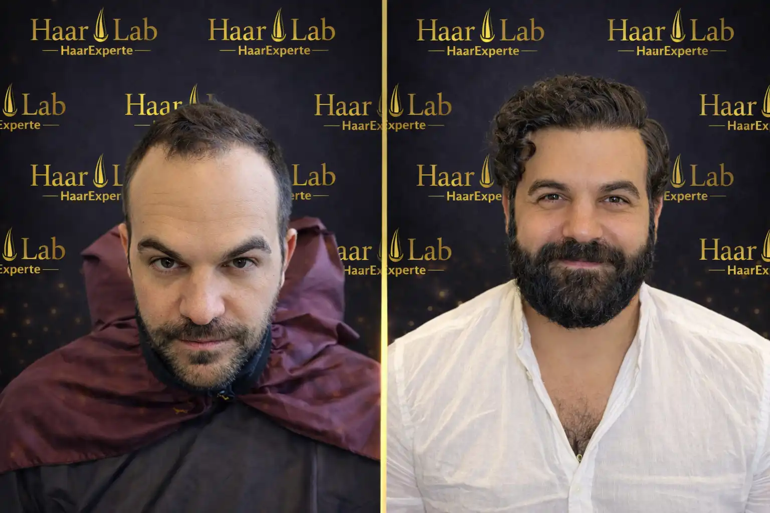Haartransplantation
