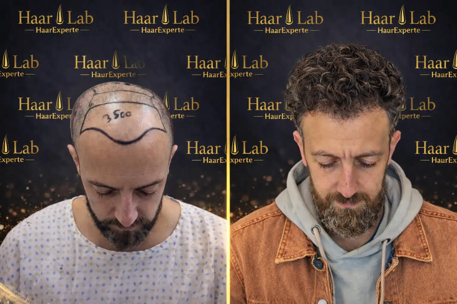 Haartransplantation