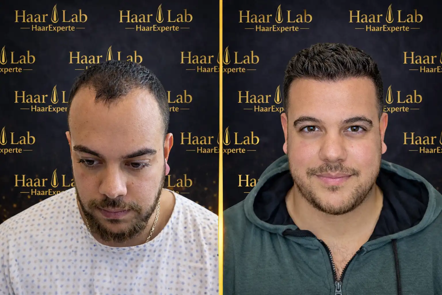 Haartransplantation