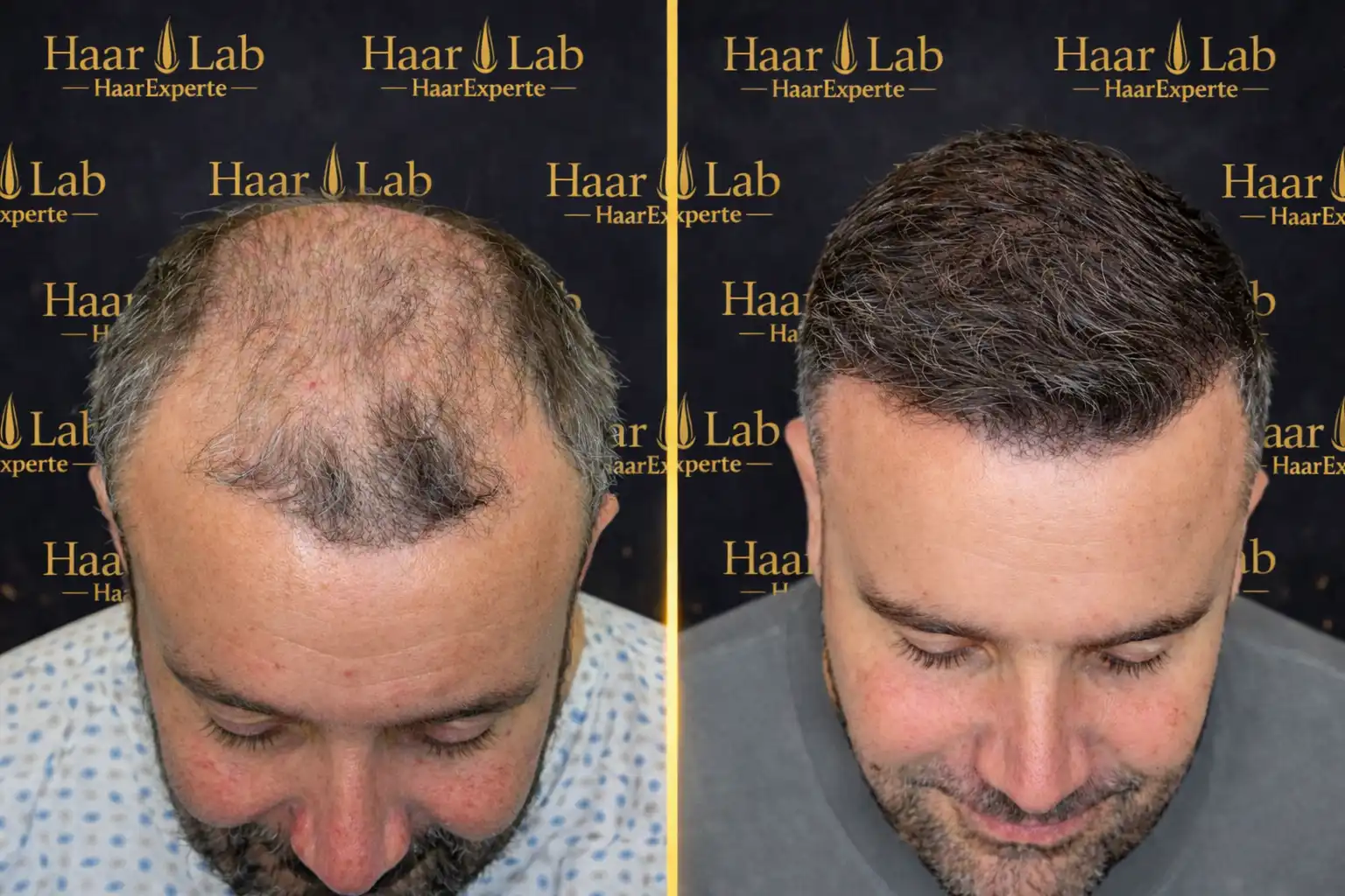 Haartransplantation
