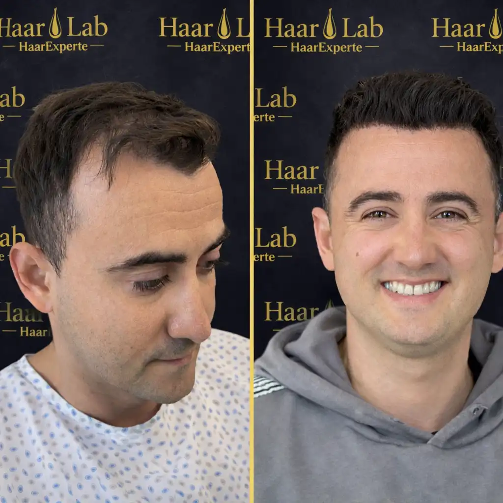 Haartransplantation