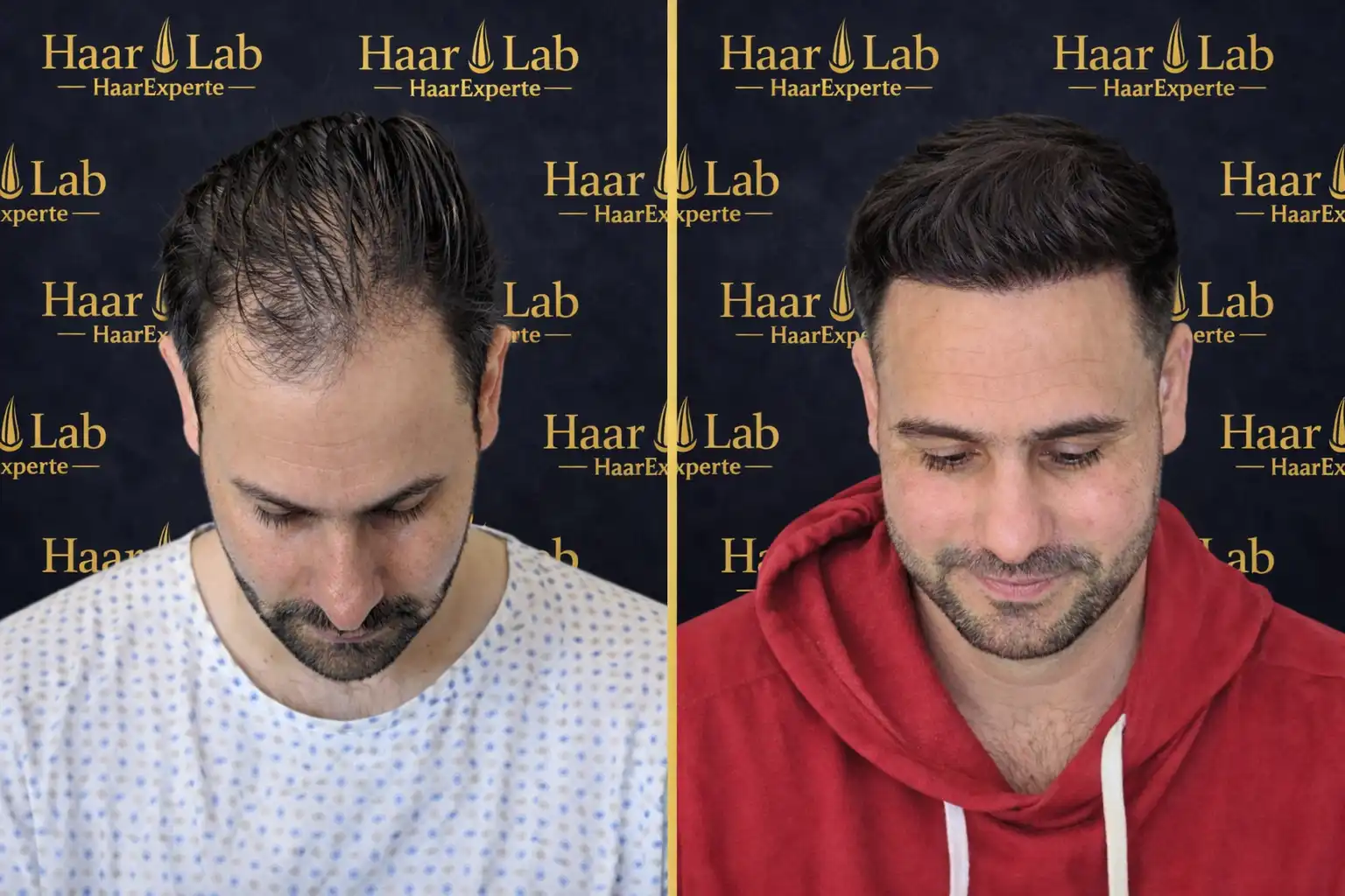 Haartransplantation
