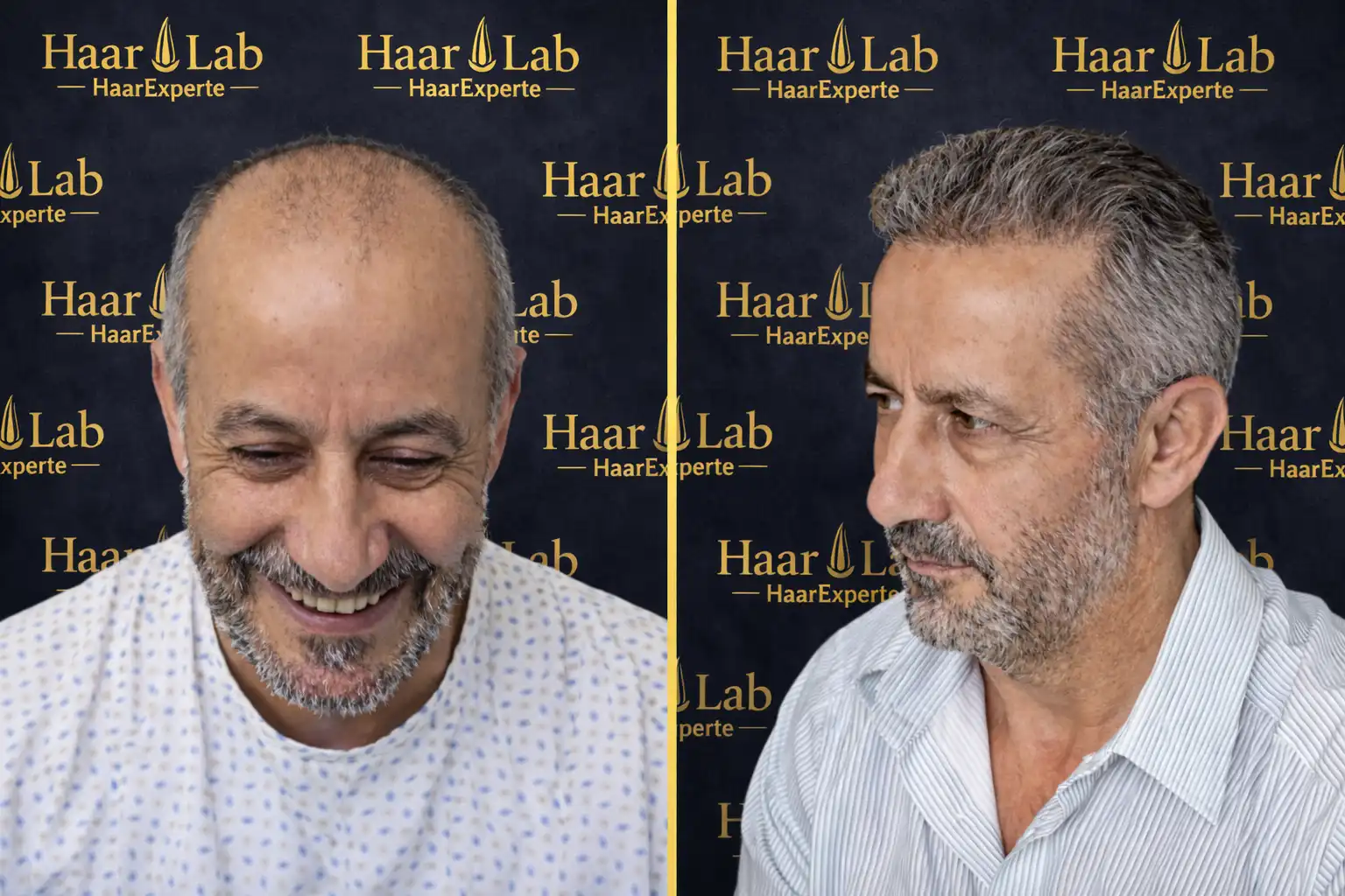Haartransplantation