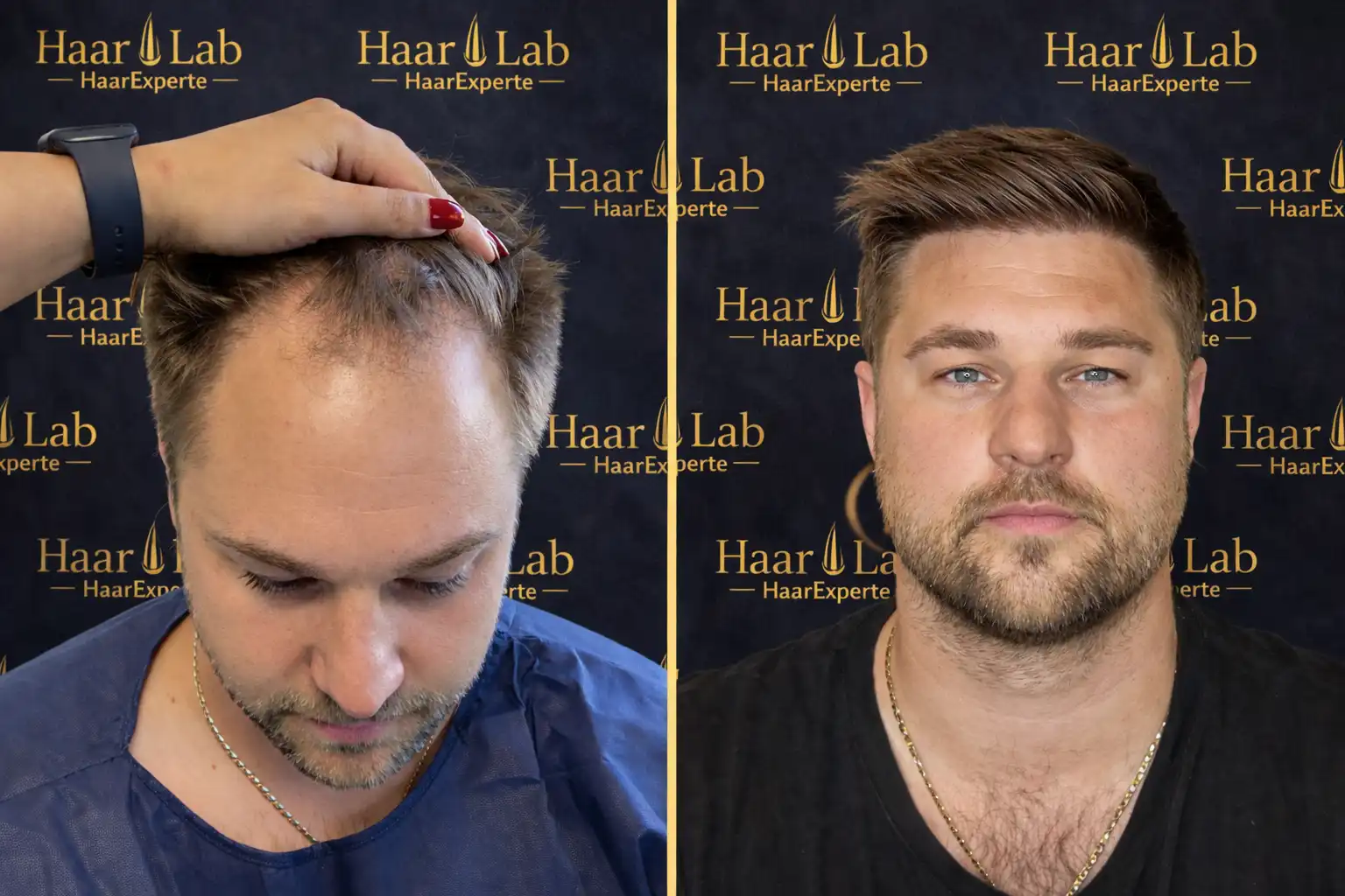 Haartransplantation