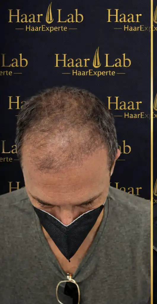 Haartransplantation Mannheim vorher
