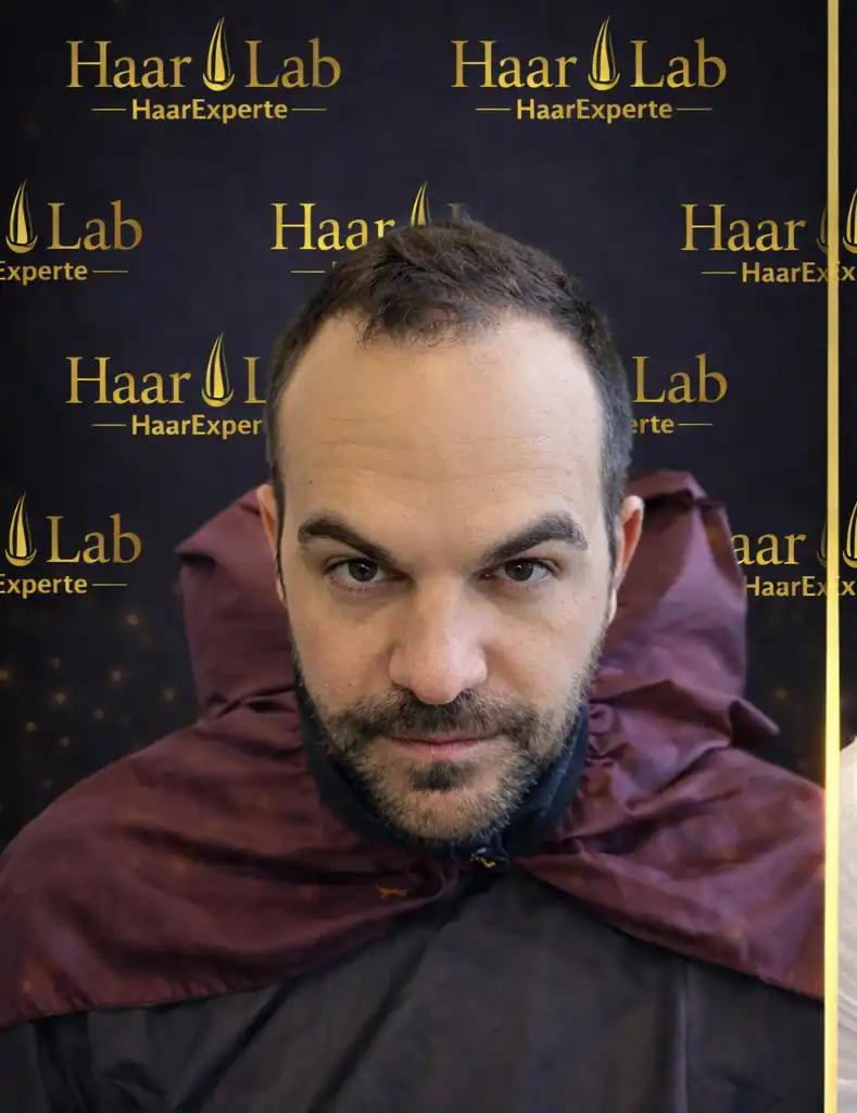 Haartransplantation Mannheim vorher