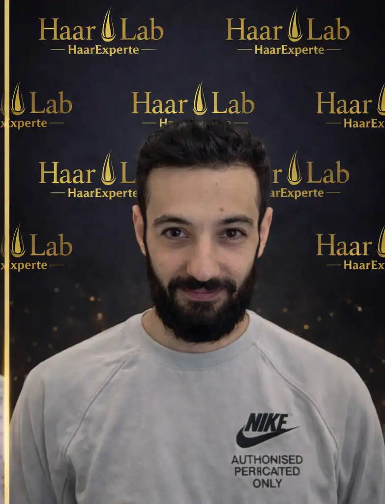 Haartransplantaion Mannheim nachher