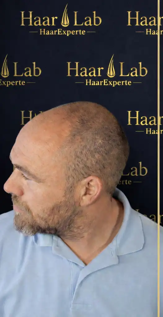 Haartransplantation Mannheim vorher