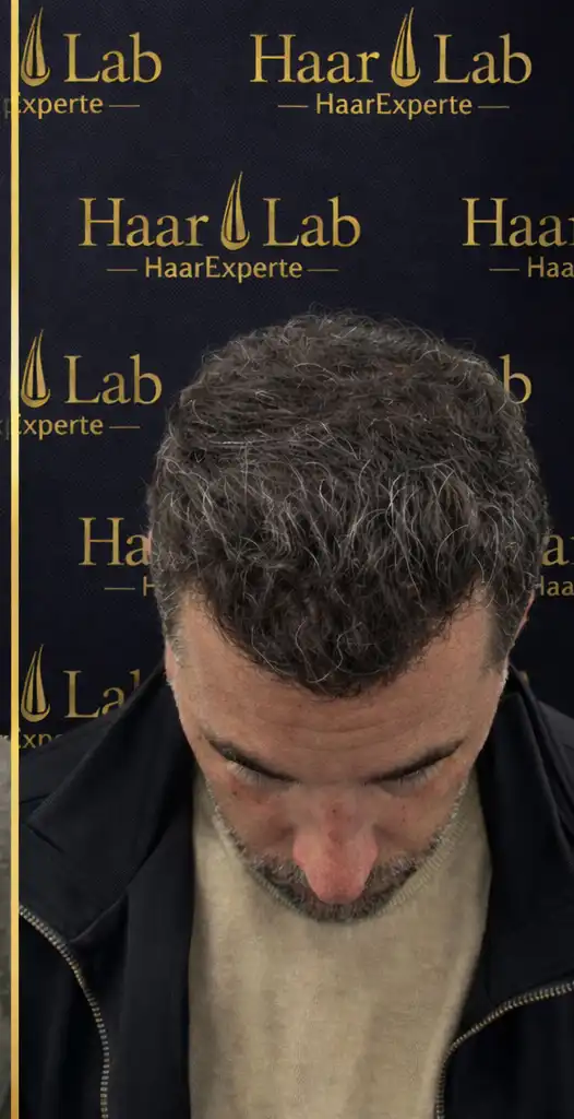 Haartransplantation Mannheim nachher