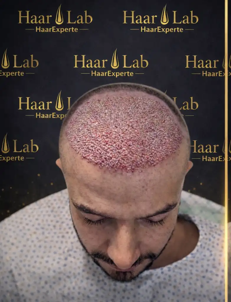 Haartransplantation Mannheim vorher