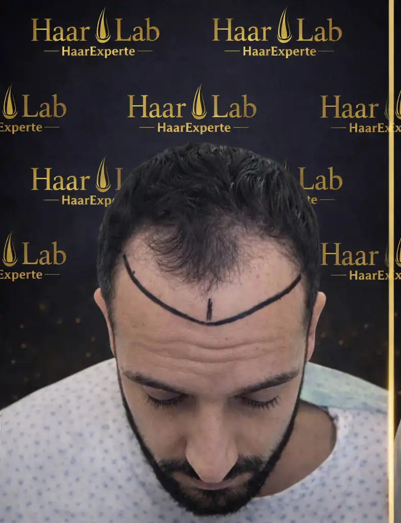 Haartransplantaion Mannheim vorher