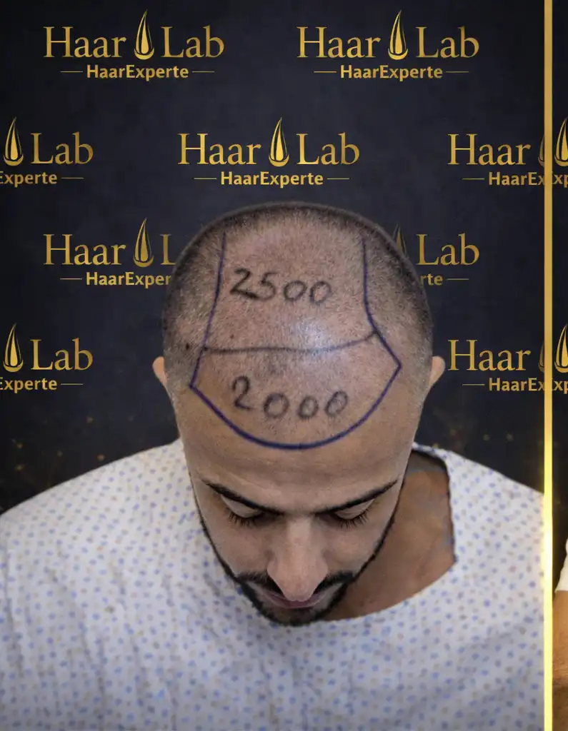 Haartransplantation Mannheim vorher