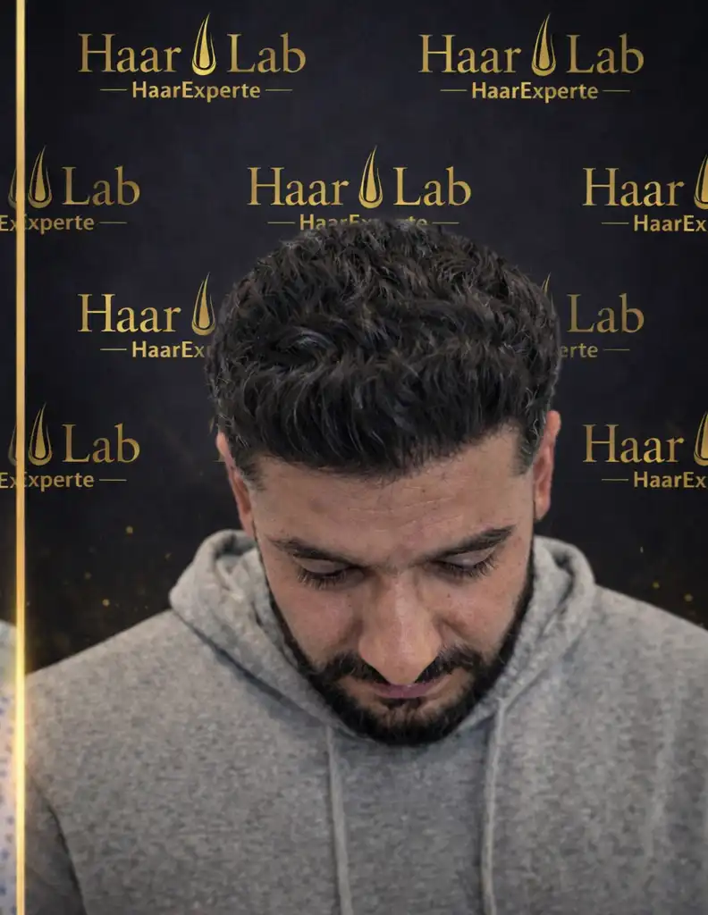 Haartransplantation Mannheim nachher