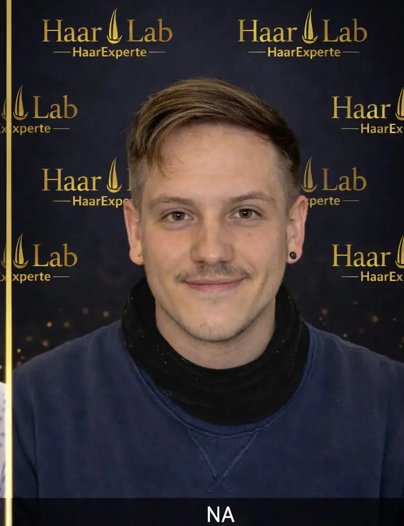 Haartransplantation Mannheim nachher