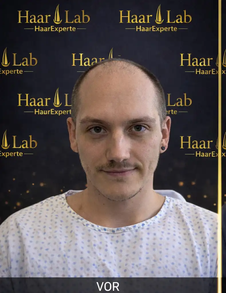 Haartransplantation Mannheim vorher
