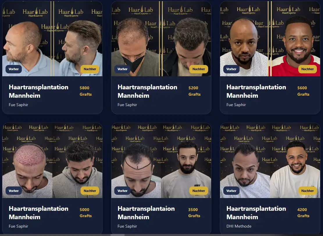 Vorher Nachher Ergebnis Saphir Haartransplantation Mannheim &ndash; HaarLab Deutschland